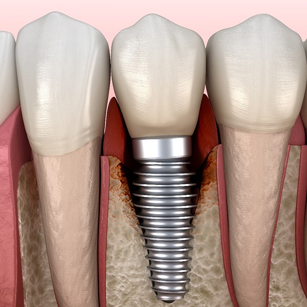 Bone loss around a failed dental implant in Hingham, MA