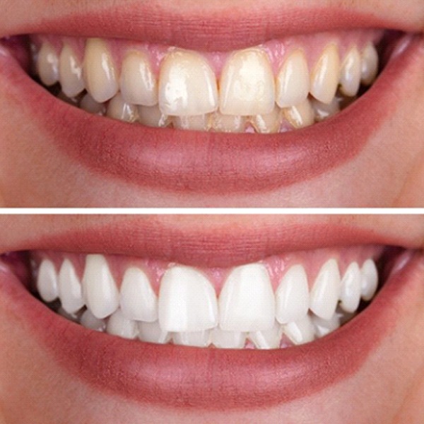 closeup of a person’s smile before and after teeth whitening