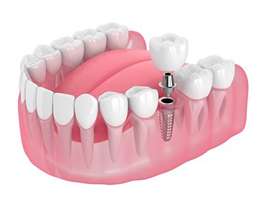 dental implant being placed in the jawbone 