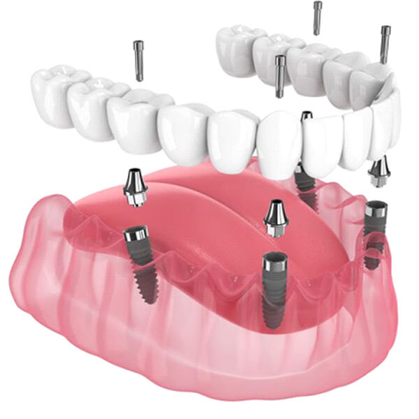 illustration of all-on-4 implants for lower dental arch