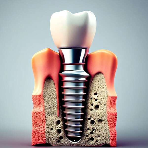 illustration showing single dental implant in jawbone