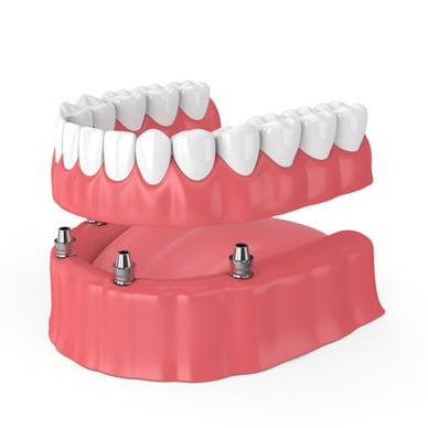Illustration of implant dentures in Hingham, MA