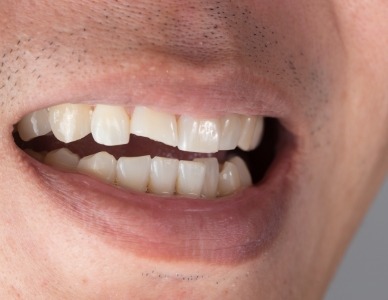 Closeup of smile with chipped front tooth