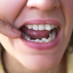 Woman with crowded teeth