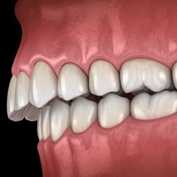 Digital illustration of an overbite