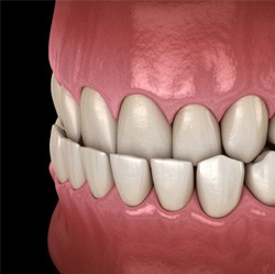 Dentist placing clear aligner on model of teeth