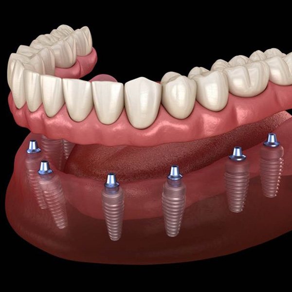 a digital illustration of implant dentures