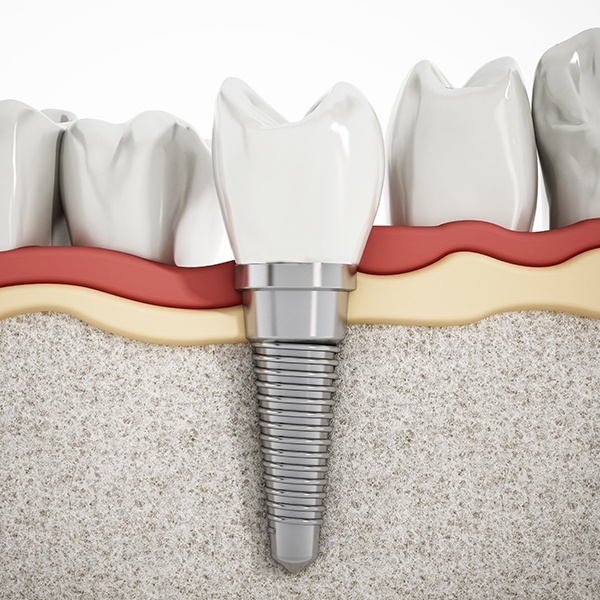 Animated smile with dental implant supported dental crown