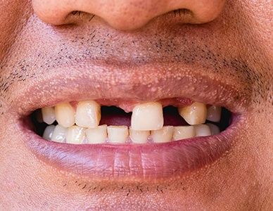 Closeup of smile with multiple missing teeth