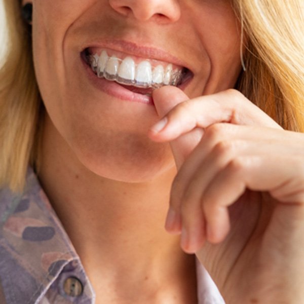 Closeup of smiling patient putting on clear aligner