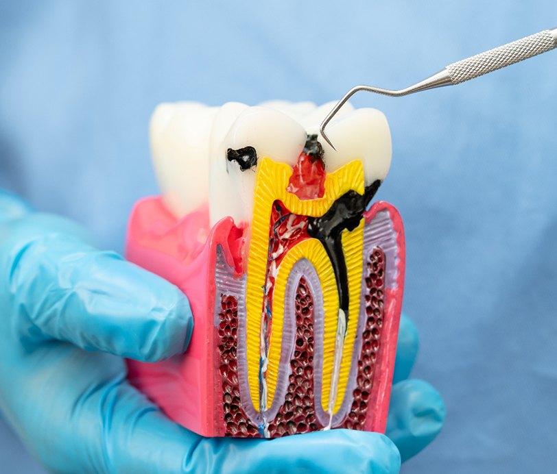 A dentist showing a model of the tooth’s root system