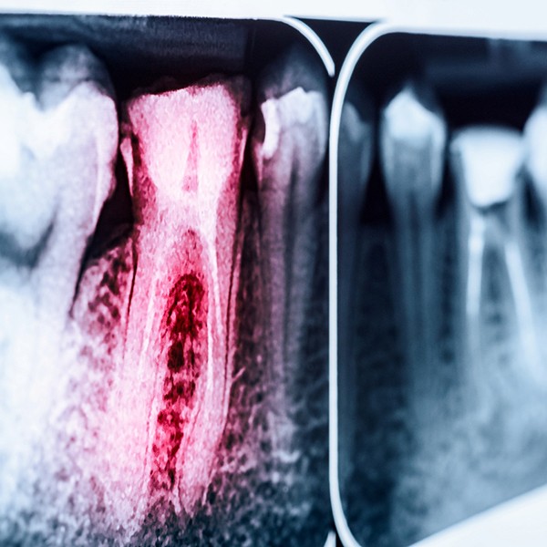 An X-ray of a tooth that needs a root canal