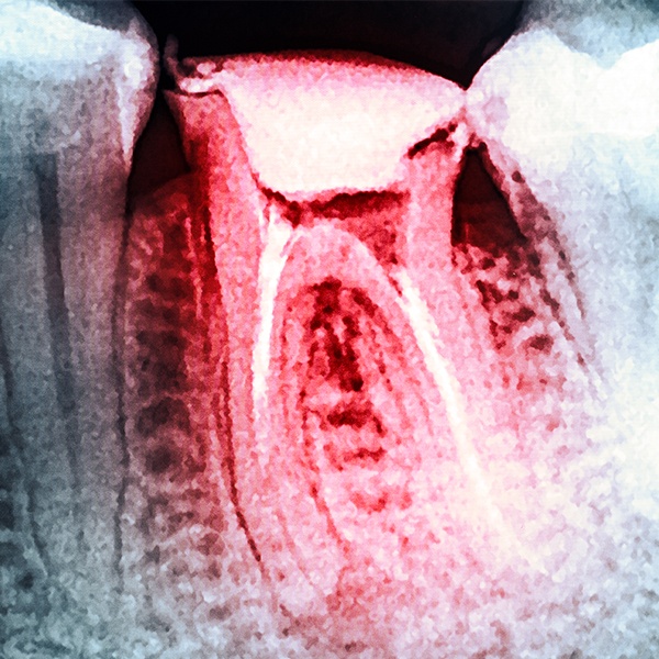 X ray of tooth after root canal treatment