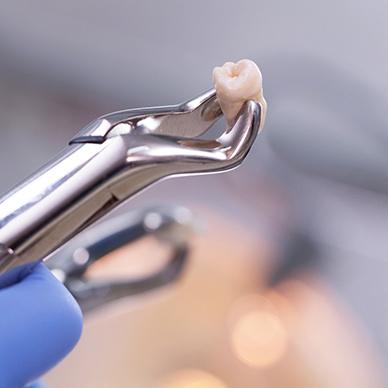 Extracted tooth held by forceps