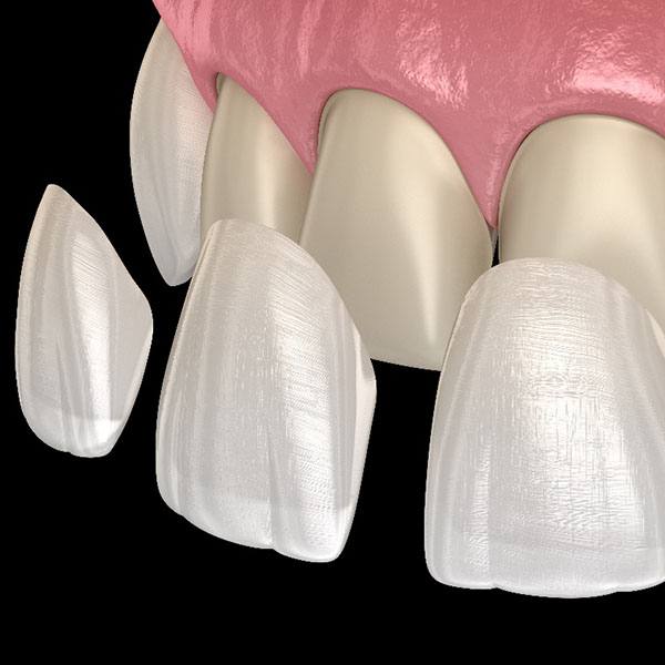 Animated smile during veneer placement
