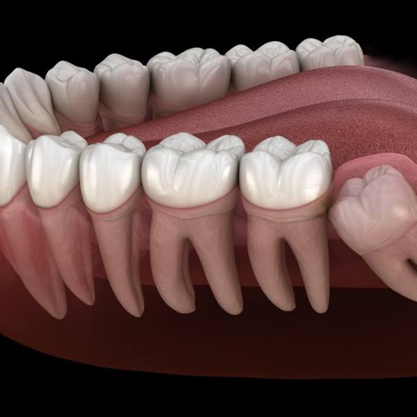 a 3D digital illustration of an impacted wisdom tooth