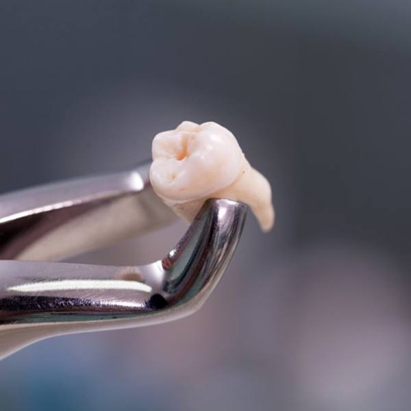 a wisdom tooth held by special dental forceps