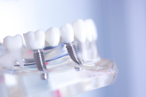 Two dental implants supporting bridge in plastic model of teeth