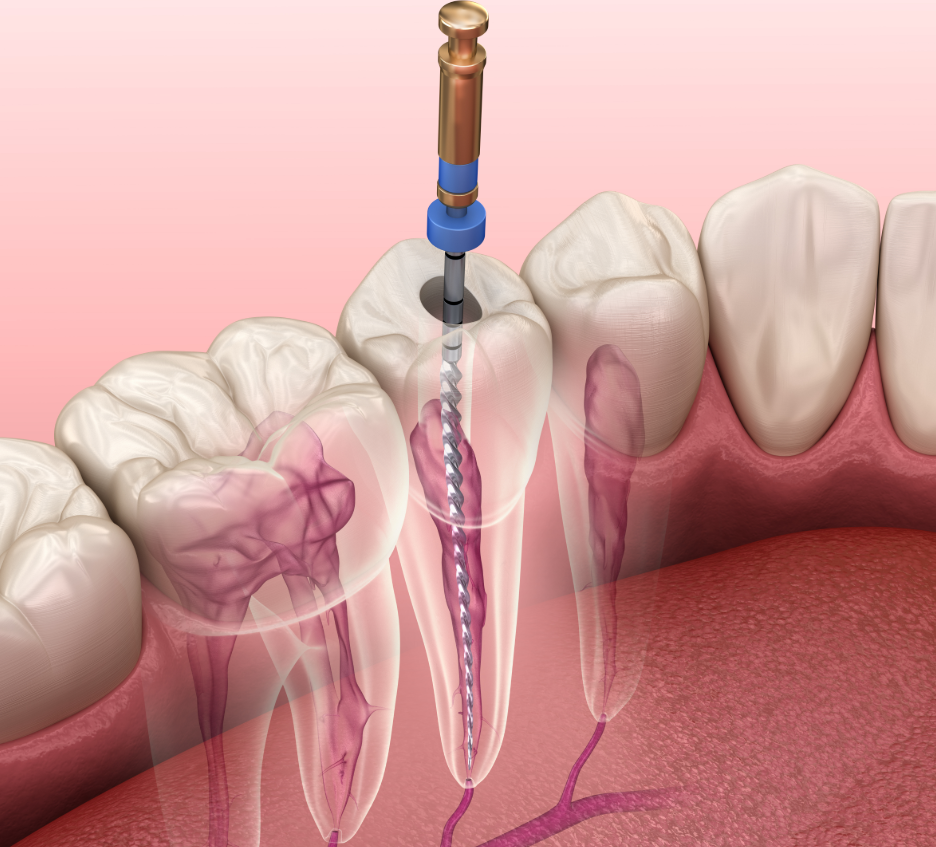 Illustration of a root canal
